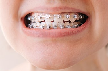 ワイヤー矯正 イメージ