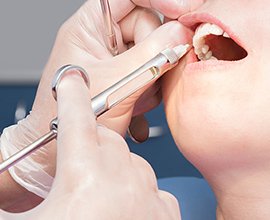 表面麻酔 イメージ